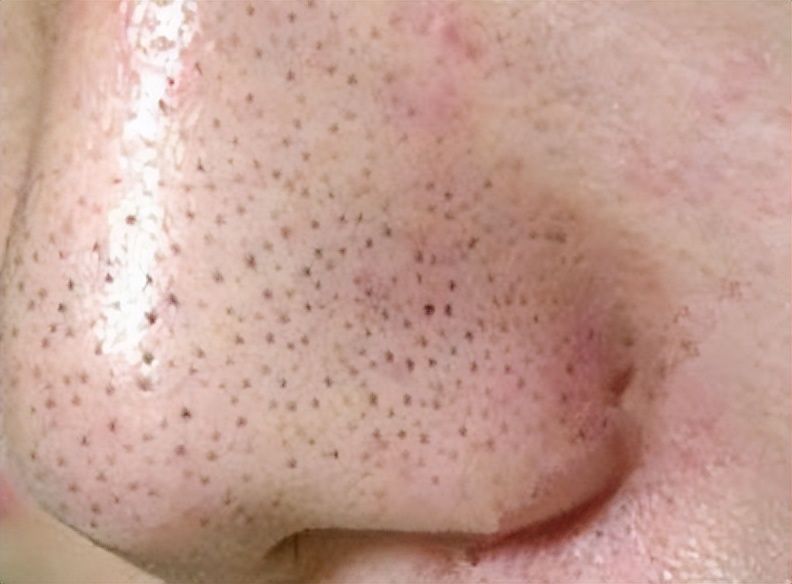 毛孔粗大黑頭多皮膚油應該怎么辦_黑頭毛孔粗大油皮怎么辦_黑頭毛孔粗大油膩用什么產品好